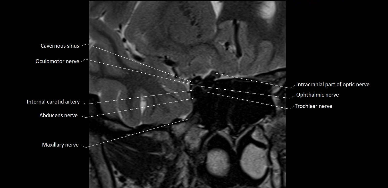 MRI Orbit coronal cross sectional anatomy image 19.webp